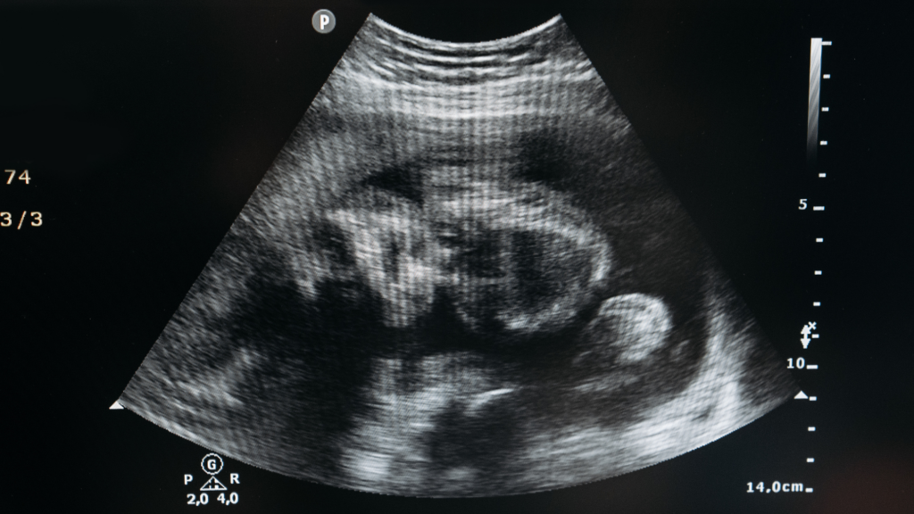 GOP Lawmakers Look to Reverse Controversial Abortion Bill from 2023